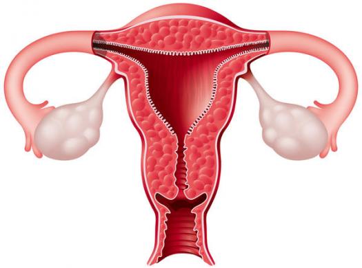 Rahim duvarı kalınlaşması olarak bilinen endometrial hiperplazi nedir?